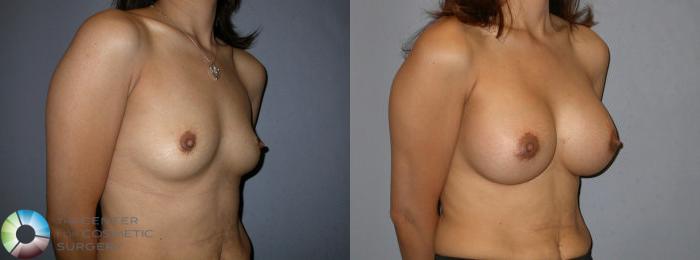 Before & After Breast Augmentation Case 83 View #2 View in Golden, CO