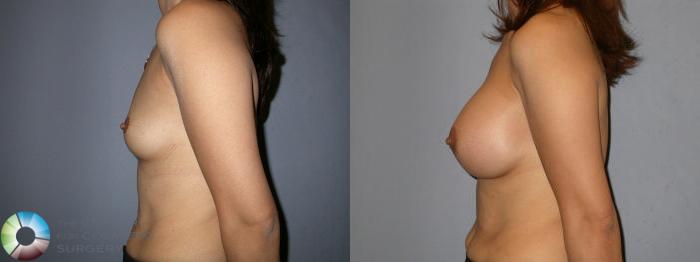 Before & After Breast Augmentation Case 83 View #3 View in Golden, CO