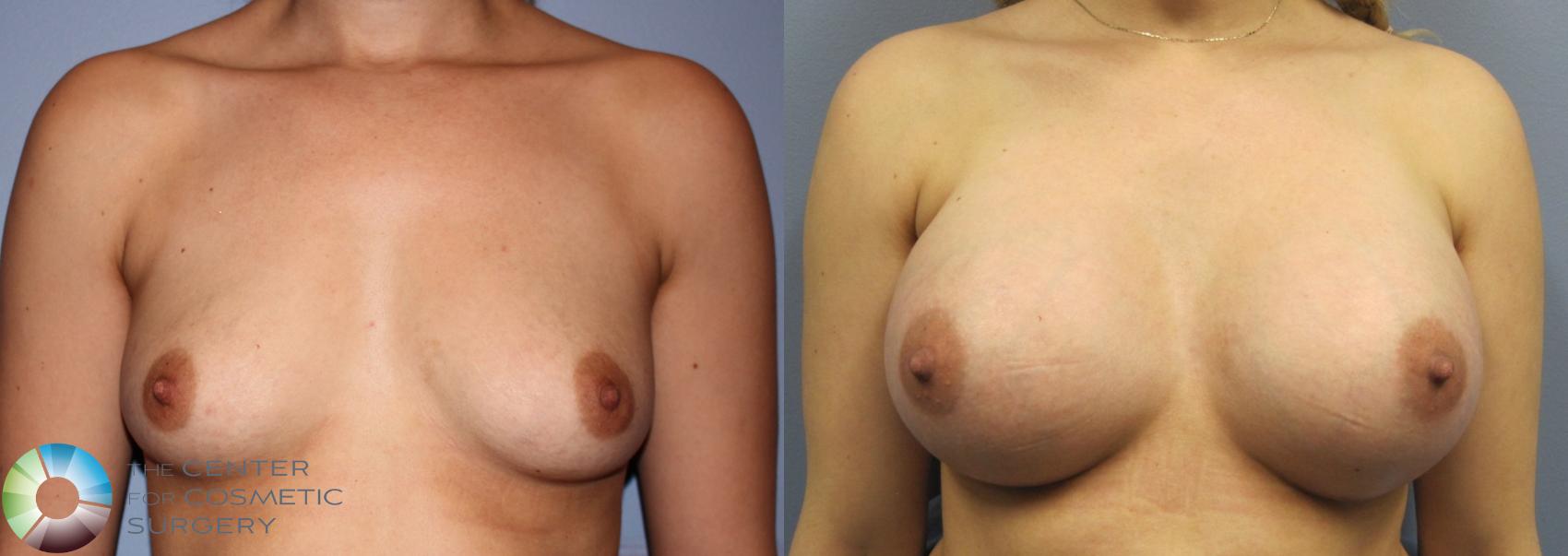 Before & After Breast Augmentation Case 833 View #1 in Denver and Colorado Springs, CO