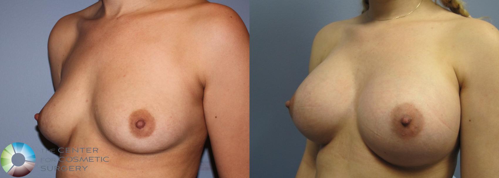 Before & After Breast Augmentation Case 833 View #2 in Denver and Colorado Springs, CO