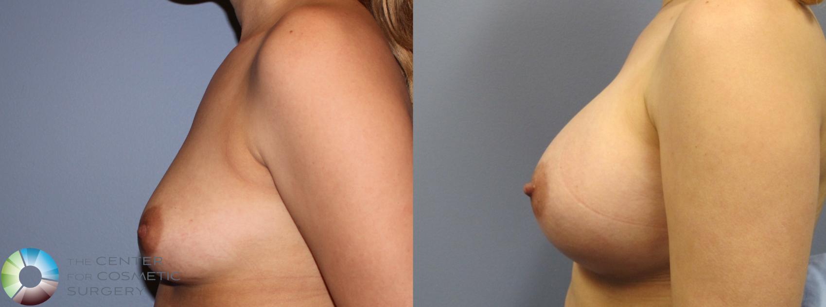 Before & After Breast Augmentation Case 833 View #3 in Denver and Colorado Springs, CO
