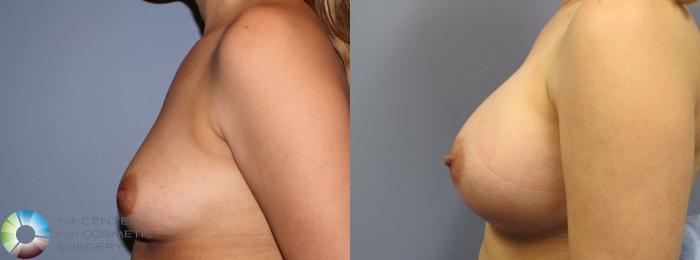 Before & After Breast Augmentation Case 833 View #3 View in Golden, CO