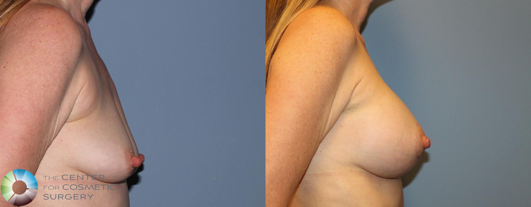 Before & After Breast Augmentation Case 834 View #1 View in Golden, CO