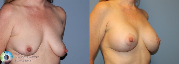 Before & After Breast Augmentation Case 834 View #2 View in Golden, CO