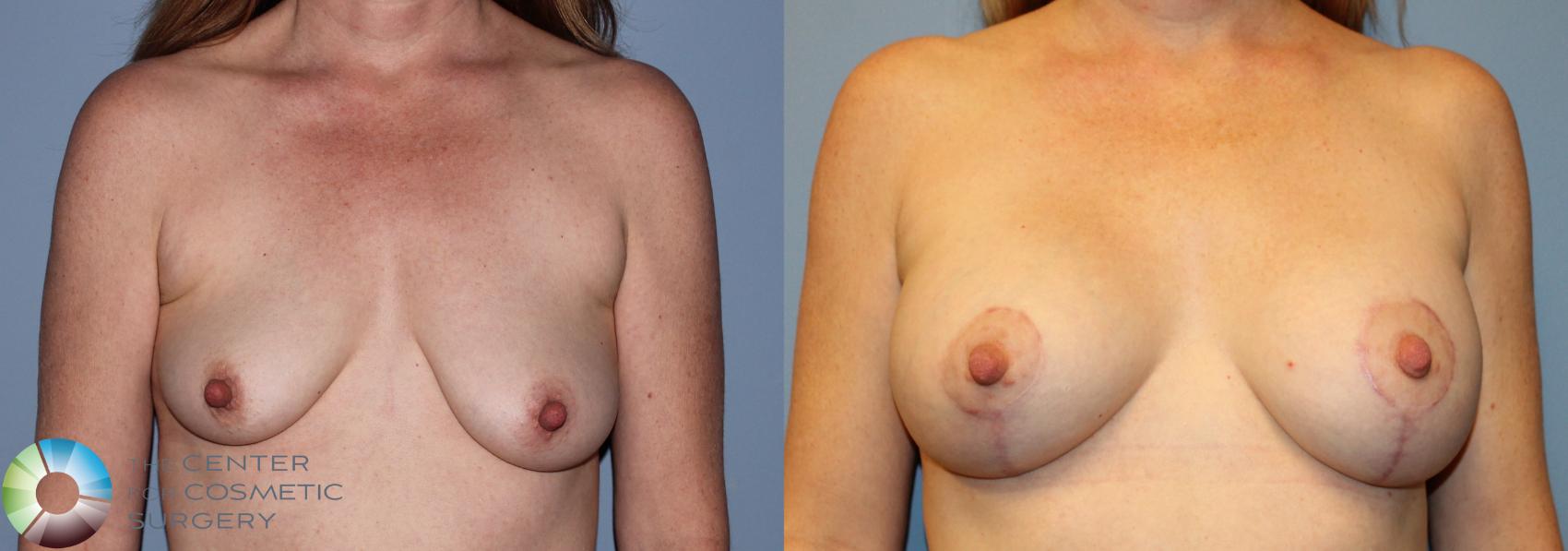 Before & After Breast Augmentation Case 834 View #3 View in Golden, CO