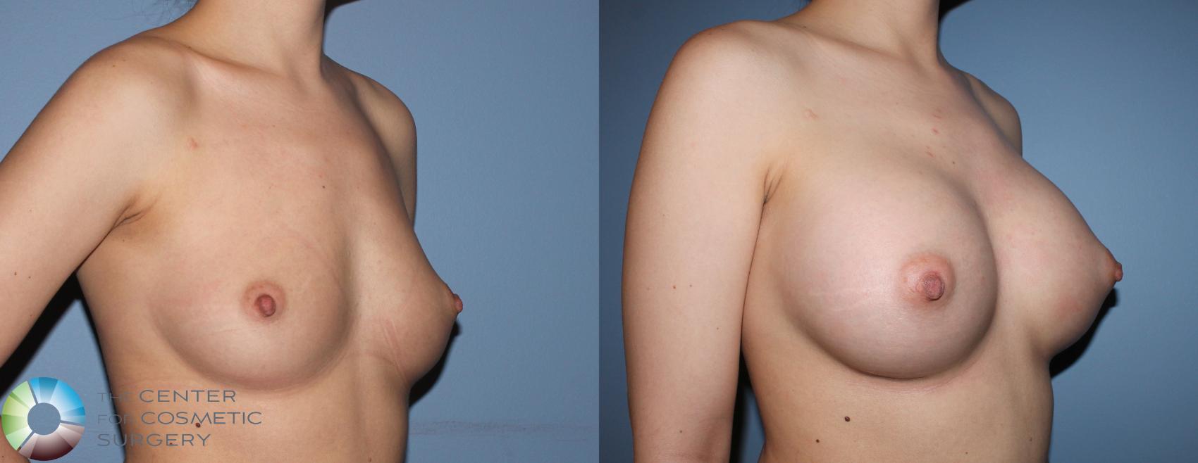 Before & After Breast Augmentation Case 837 View #1 in Denver and Colorado Springs, CO