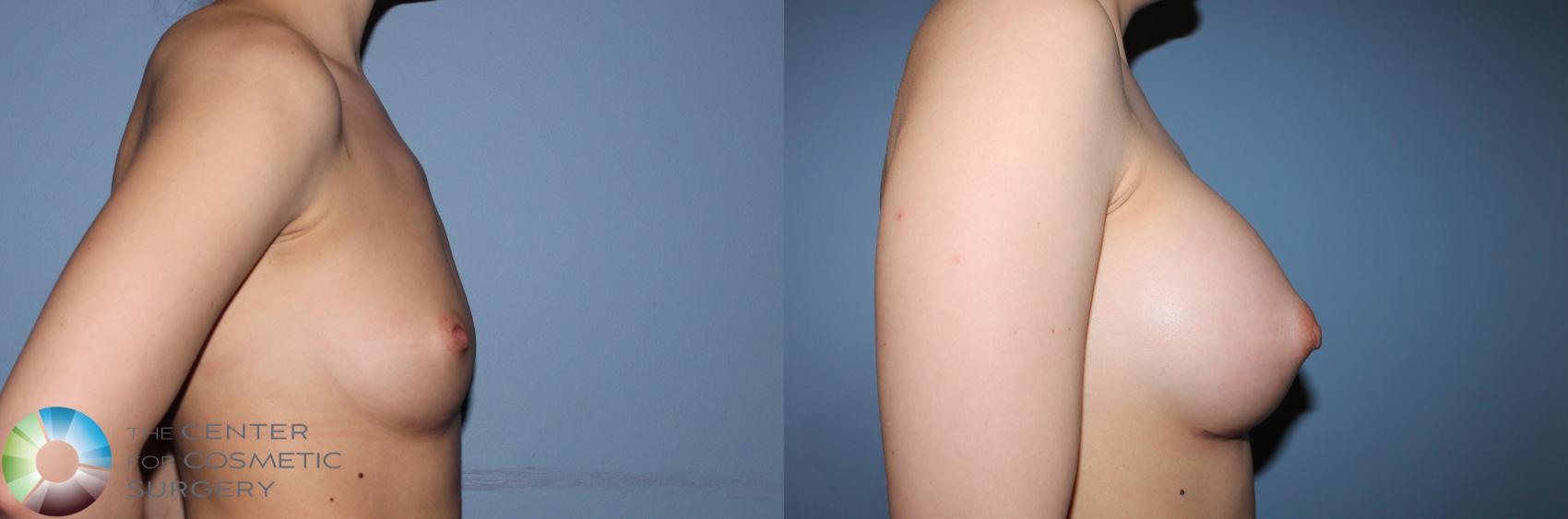 Before & After Breast Augmentation Case 837 View #2 in Denver and Colorado Springs, CO