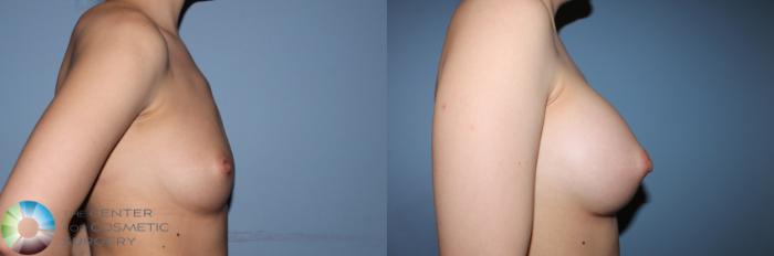 Before & After Breast Augmentation Case 837 View #2 View in Golden, CO