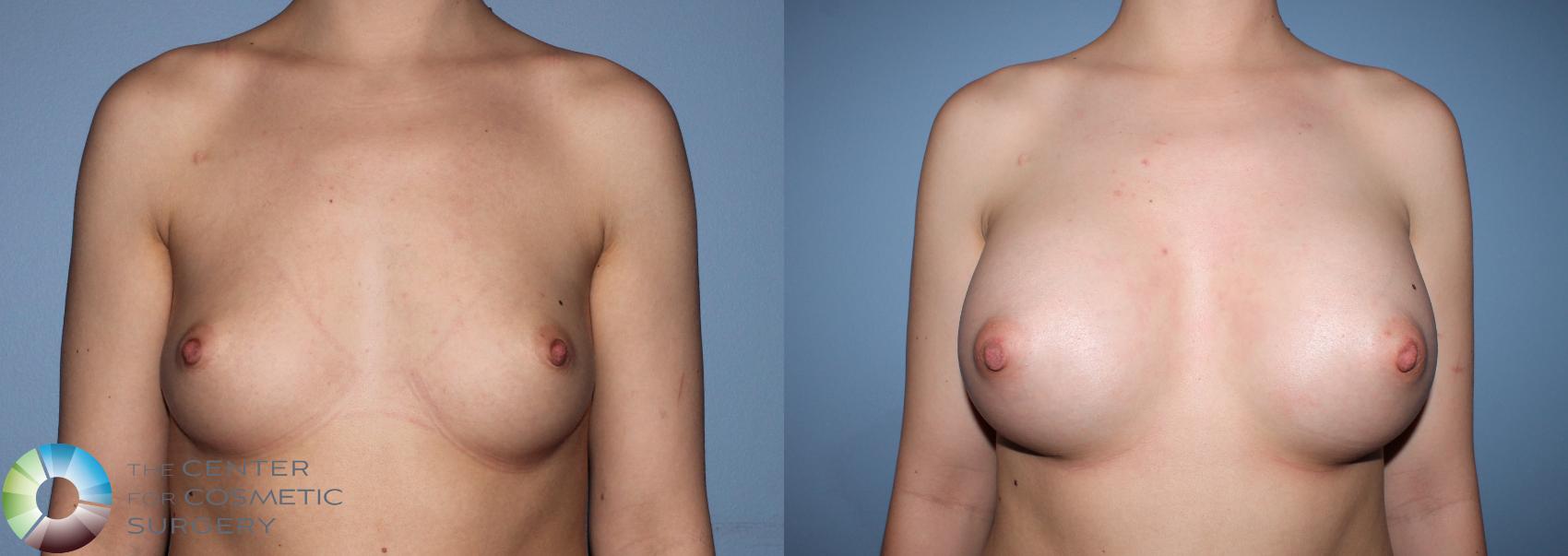Before & After Breast Augmentation Case 837 View #3 in Denver and Colorado Springs, CO