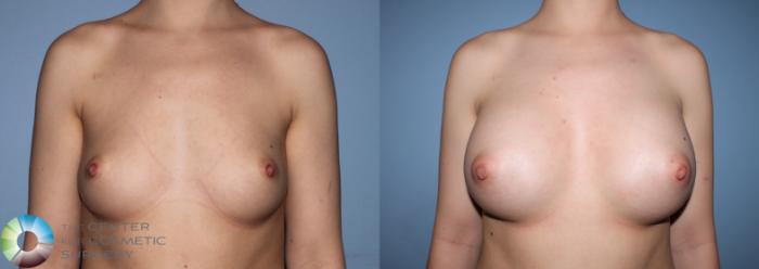 Before & After Breast Augmentation Case 837 View #3 View in Golden, CO