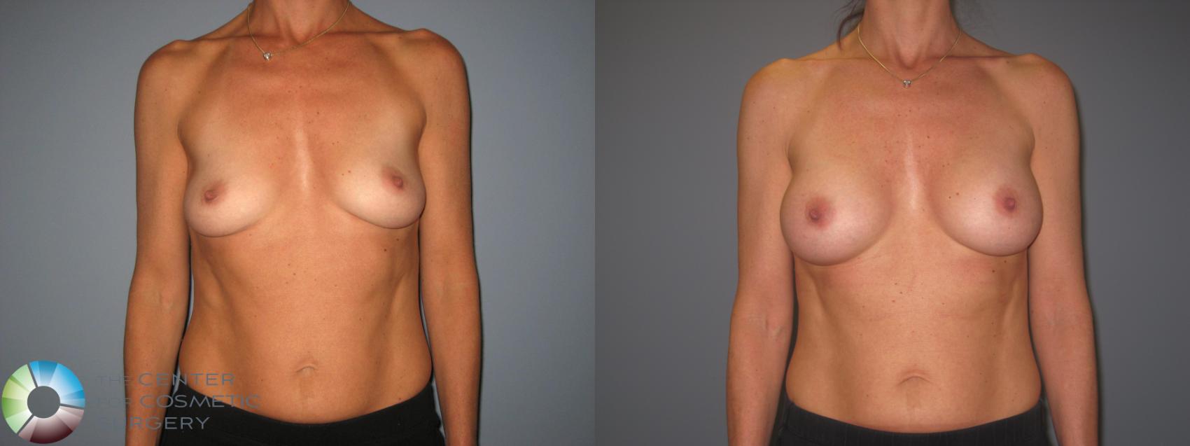 Before & After Breast Augmentation Case 843 View #1 in Denver and Colorado Springs, CO