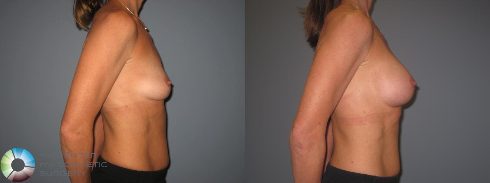 Before & After Breast Augmentation Case 843 View #2 View in Golden, CO