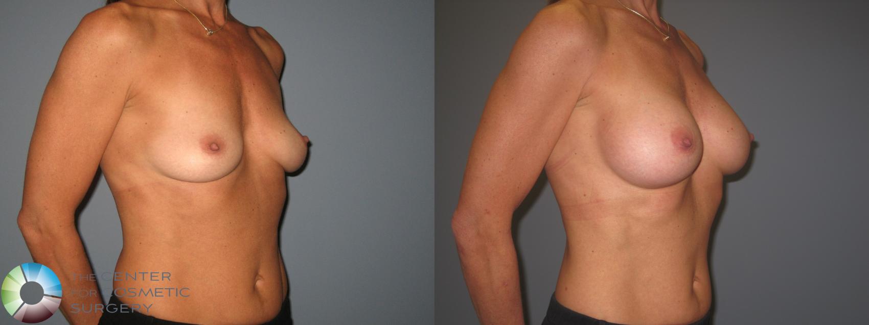 Before & After Breast Augmentation Case 843 View #3 View in Golden, CO
