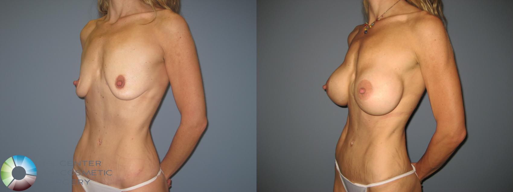 Before & After Breast Augmentation Case 846 View #1 in Denver and Colorado Springs, CO