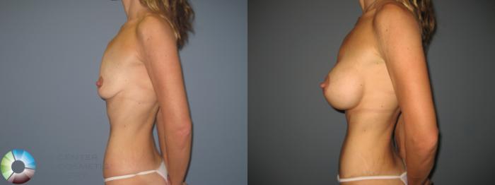 Before & After Breast Augmentation Case 846 View #2 in Denver and Colorado Springs, CO
