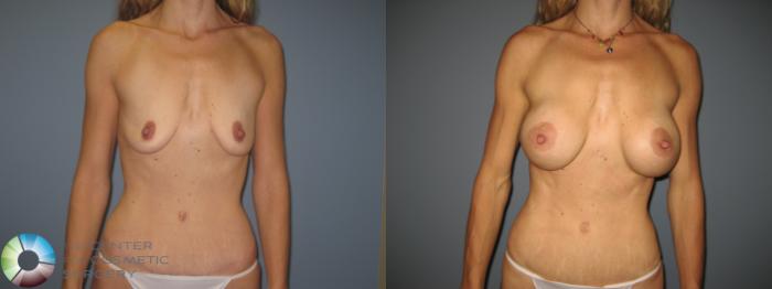 Before & After Breast Augmentation Case 846 View #3 in Denver and Colorado Springs, CO