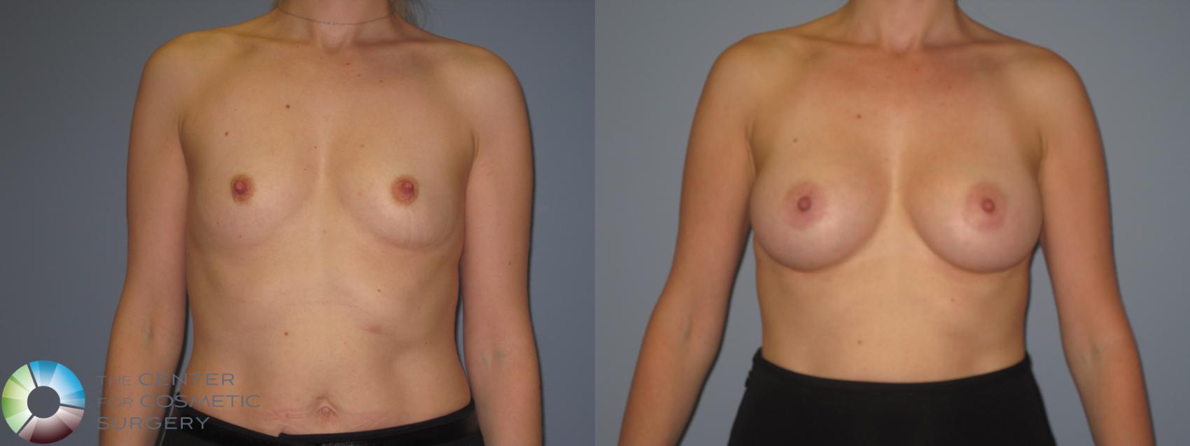 Before & After Breast Augmentation Case 848 View #1 in Denver, CO