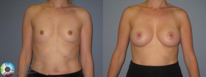 Before & After Breast Augmentation Case 848 View #1 View in Golden, CO