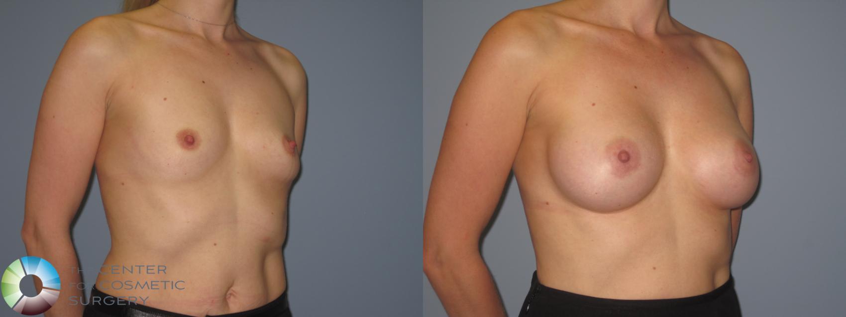 Before & After Breast Augmentation Case 848 View #2 in Denver and Colorado Springs, CO
