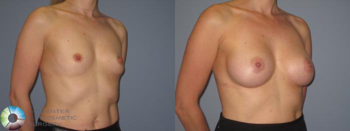 Before & After Breast Augmentation Case 848 View #2 View in Golden, CO