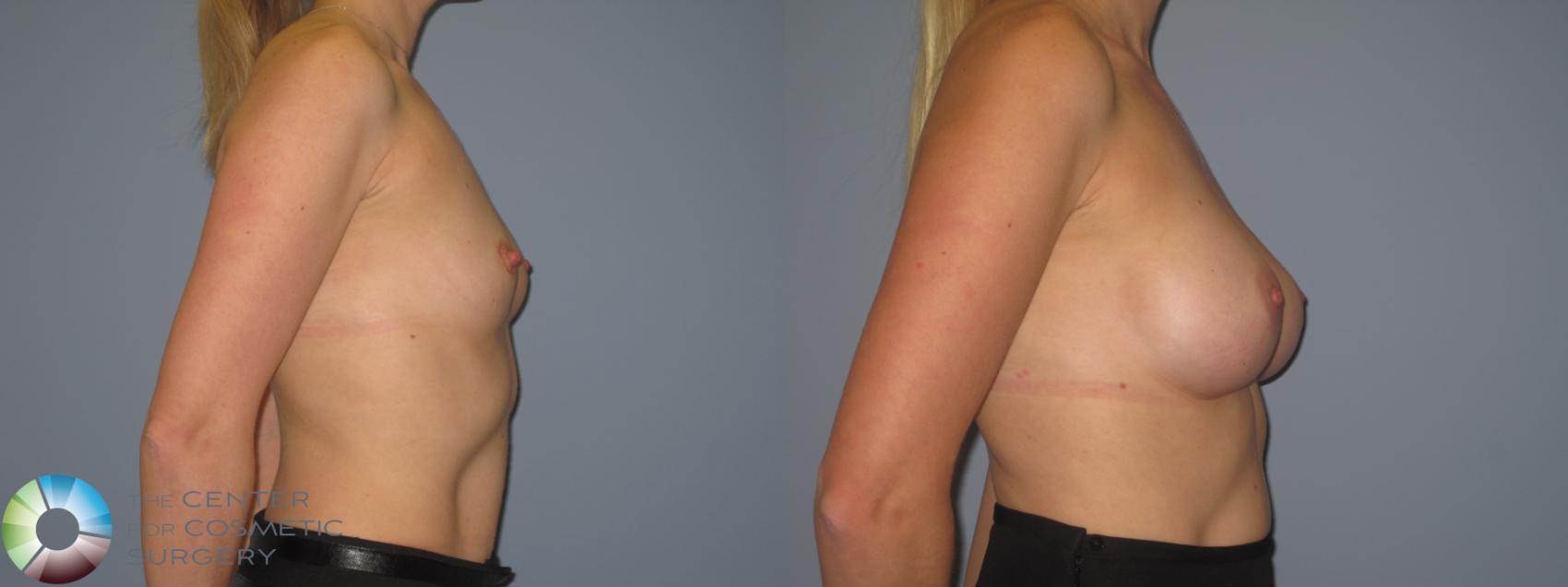 Before & After Breast Augmentation Case 848 View #3 in Denver and Colorado Springs, CO