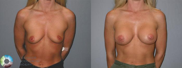 Before & After Breast Augmentation Case 85 View #1 in Denver and Colorado Springs, CO