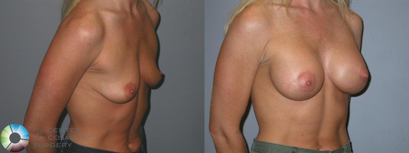 Before & After Breast Augmentation Case 85 View #2 View in Golden, CO