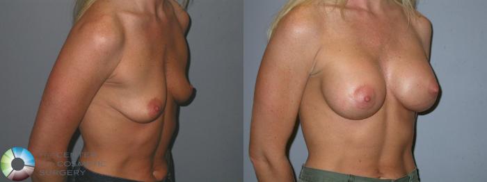 Before & After Breast Augmentation Case 85 View #2 in Denver and Colorado Springs, CO