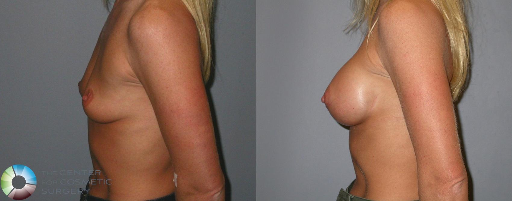 Before & After Breast Augmentation Case 85 View #3 View in Golden, CO