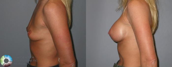 Before & After Breast Augmentation Case 85 View #3 in Denver and Colorado Springs, CO
