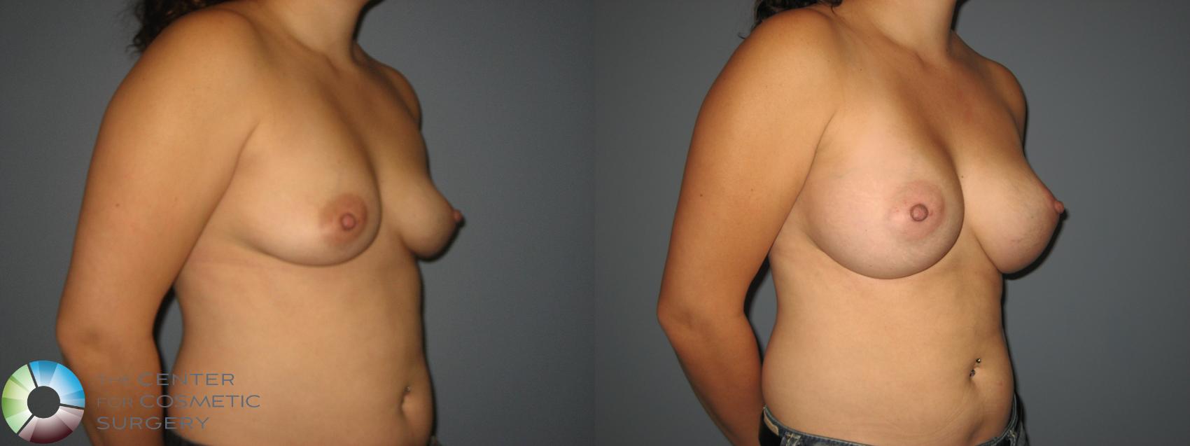 Before & After Breast Augmentation Case 850 View #1 in Denver and Colorado Springs, CO