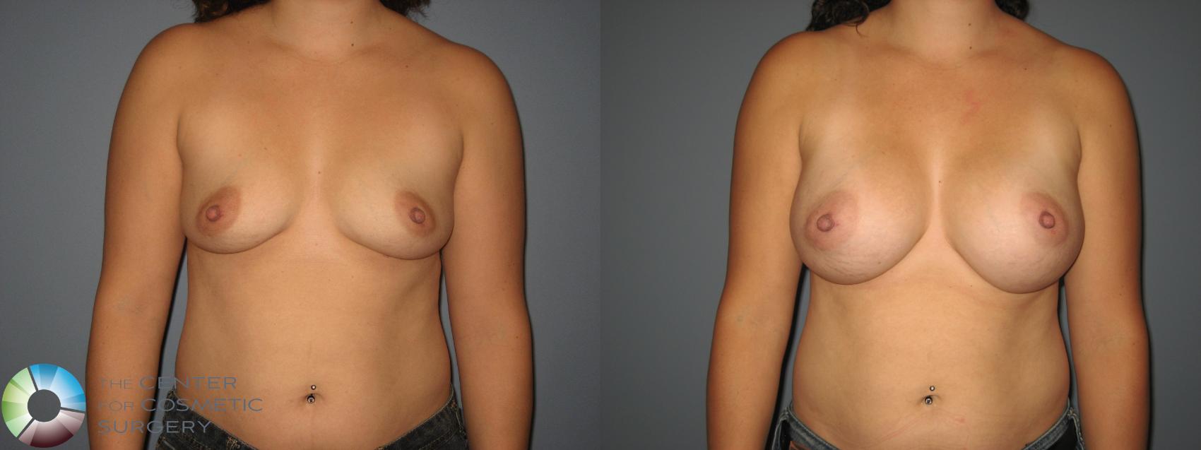 Before & After Breast Augmentation Case 850 View #2 View in Golden, CO