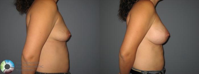 Before & After Breast Augmentation Case 850 View #3 View in Golden, CO