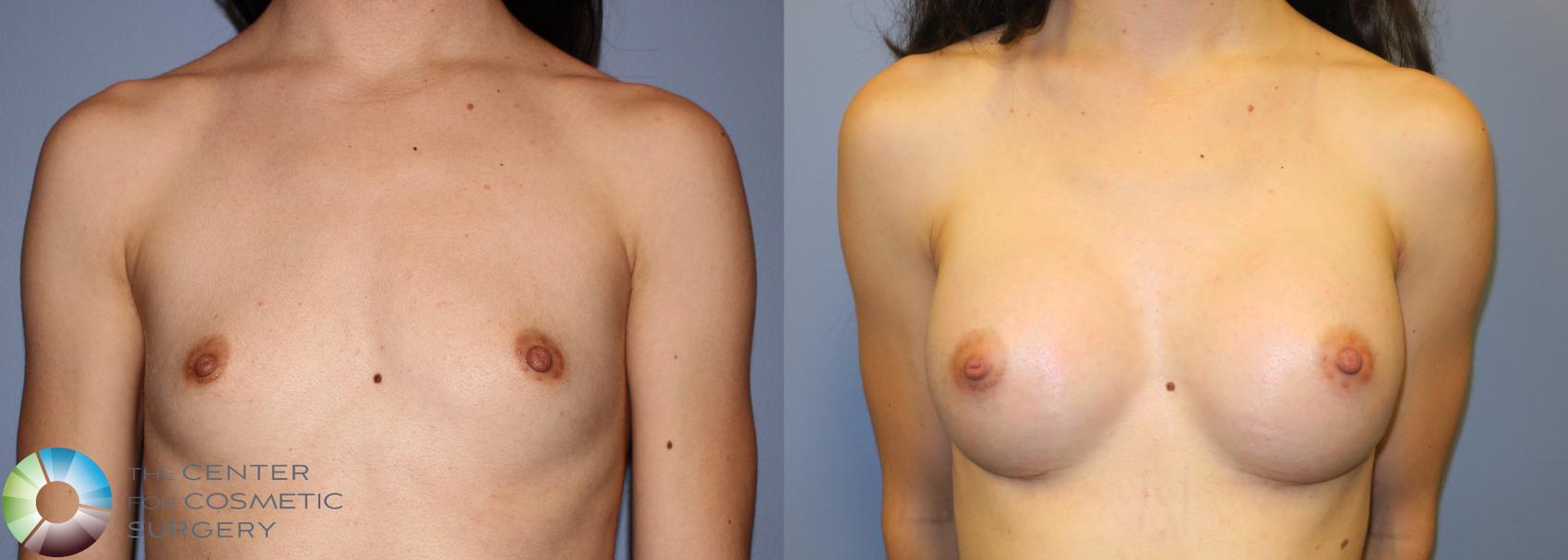 Before & After Breast Augmentation Case 859 View #1 in Denver and Colorado Springs, CO