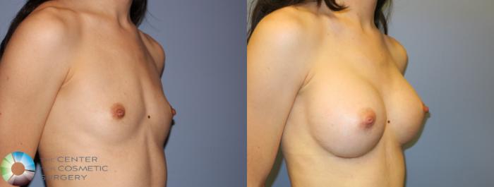 Before & After Breast Augmentation Case 859 View #2 View in Golden, CO