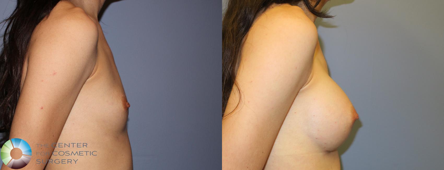 Before & After Breast Augmentation Case 859 View #3 View in Golden, CO