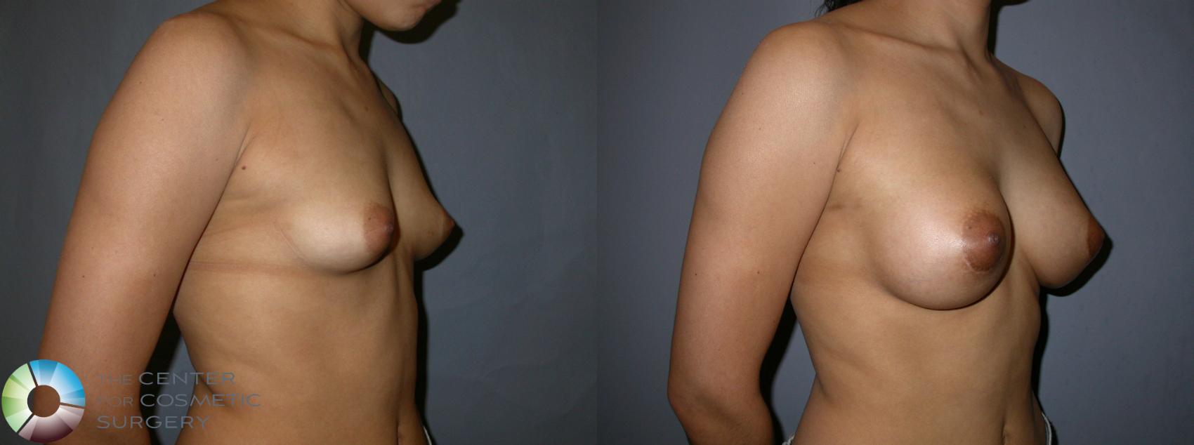 Before & After Breast Augmentation Case 86 View #1 in Denver, CO