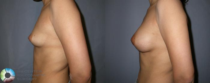 Before & After Breast Augmentation Case 86 View #2 View in Golden, CO