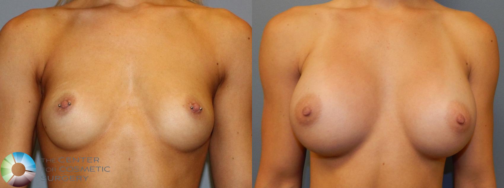 Before & After Breast Augmentation Case 860 View #1 in Denver and Colorado Springs, CO