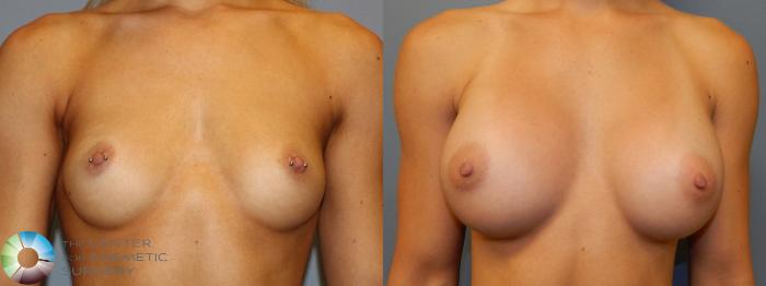 Before & After Breast Augmentation Case 860 View #1 View in Golden, CO