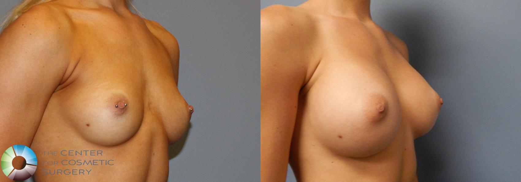 Before & After Breast Augmentation Case 860 View #2 in Denver and Colorado Springs, CO
