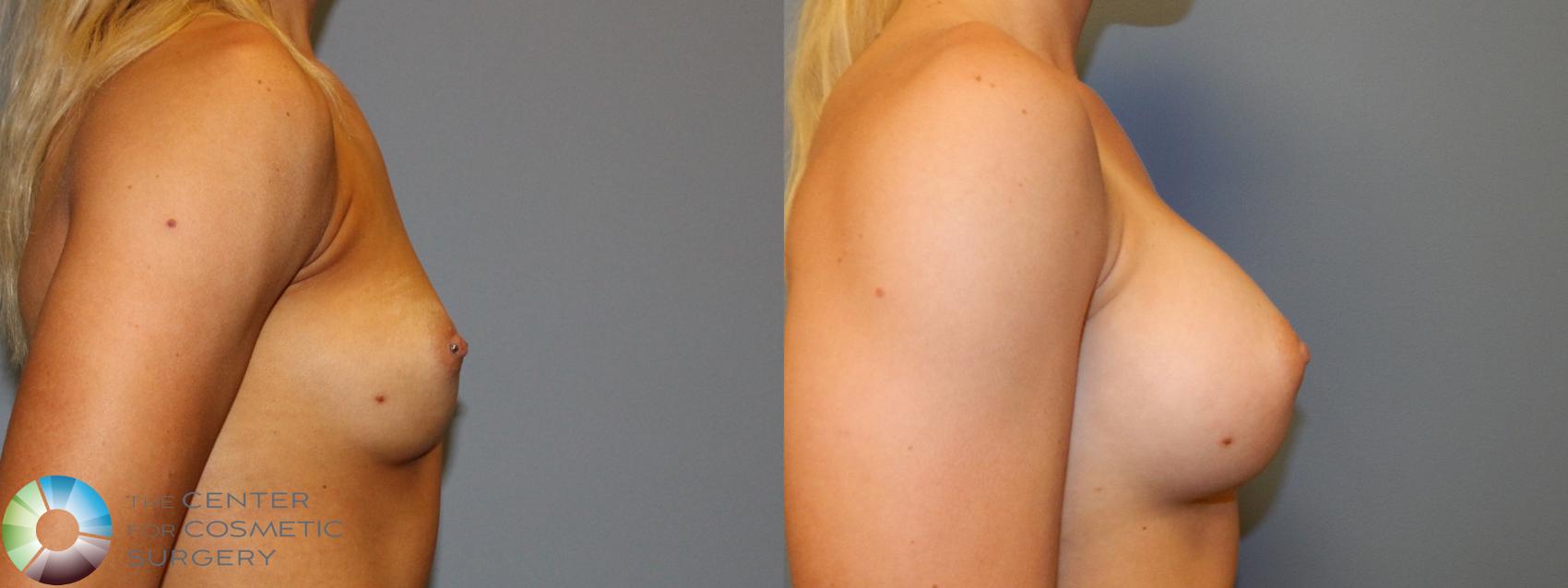 Before & After Breast Augmentation Case 860 View #3 in Denver and Colorado Springs, CO