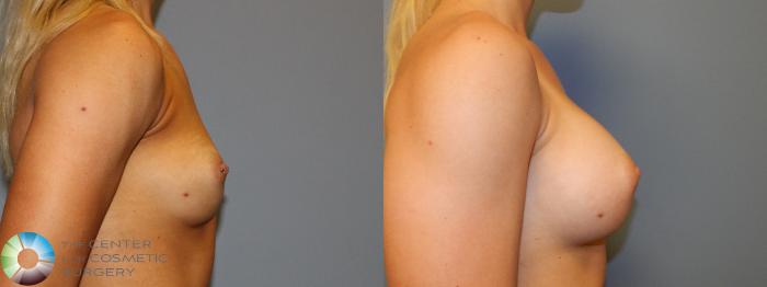 Before & After Breast Augmentation Case 860 View #3 View in Golden, CO