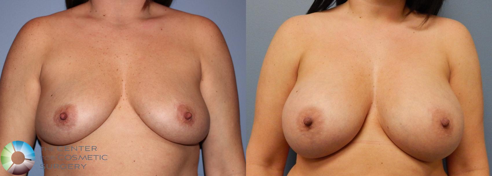 Before & After Breast Augmentation Case 863 View #1 in Denver, CO