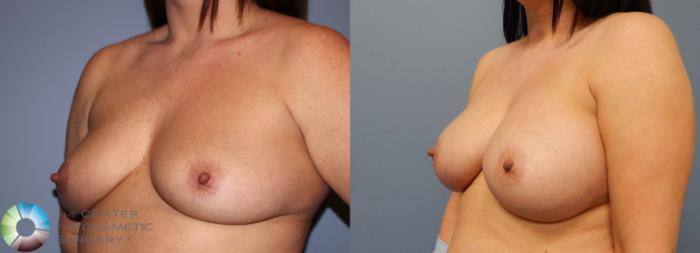 Before & After Breast Augmentation Case 863 View #2 View in Golden, CO