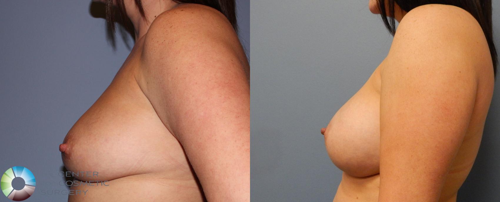 Before & After Breast Augmentation Case 863 View #3 View in Golden, CO