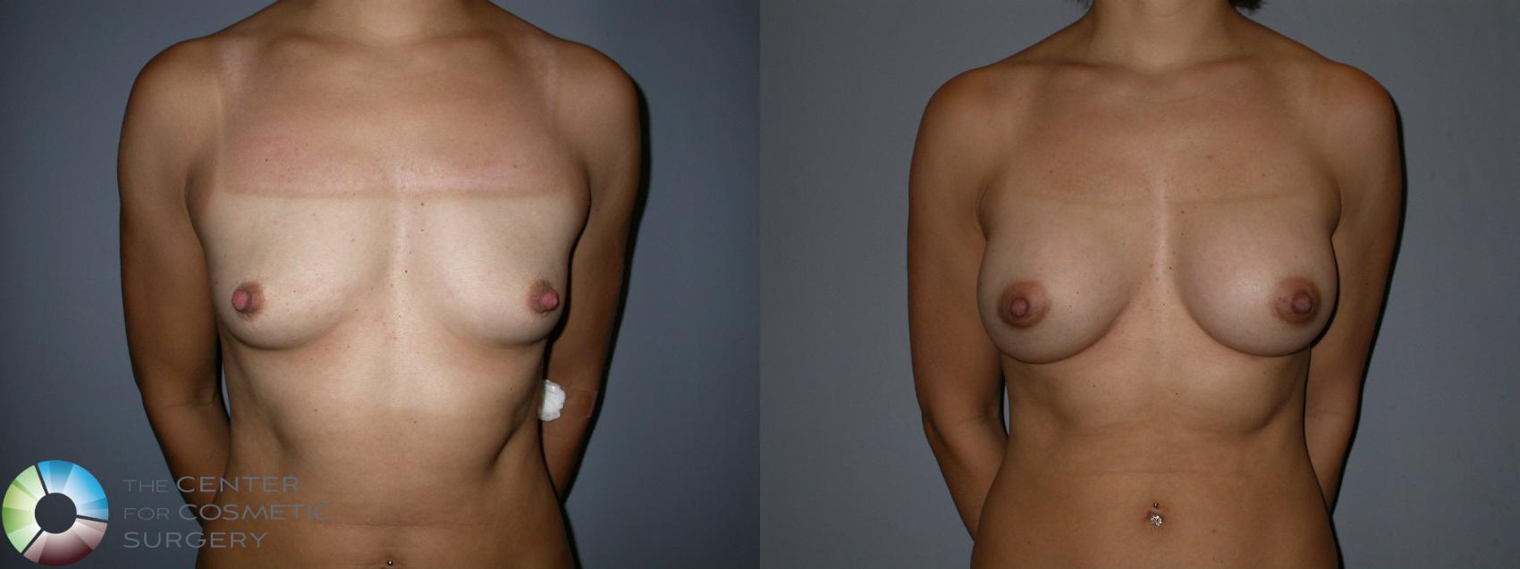 Before & After Breast Augmentation Case 87 View #1 in Denver and Colorado Springs, CO