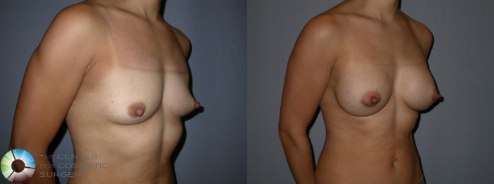 Before & After Breast Augmentation Case 87 View #2 View in Golden, CO