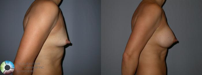 Before & After Breast Augmentation Case 87 View #3 View in Golden, CO