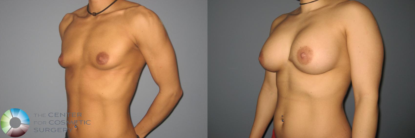 Before & After Breast Augmentation Case 870 View #1 in Denver and Colorado Springs, CO